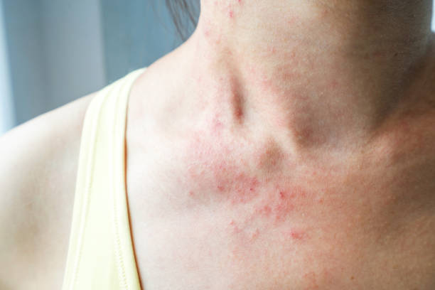 Holistic Approach to Clear Skin Homeopathic Acne Pills and Meal Plan for Acne