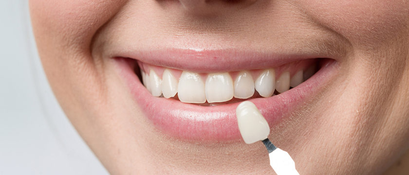 Hiring the Right Dentist for Dental Veneers: What to Look For