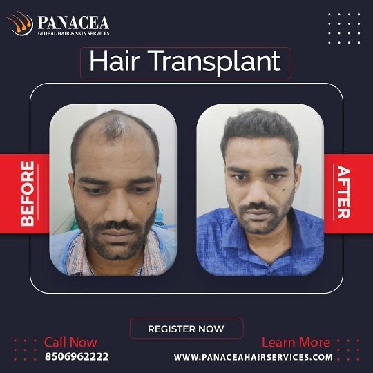 Best Hair Transplant in Delhi, India at the Best Hair Clinic in Delhi – Panacea Global Hair & Skin Services