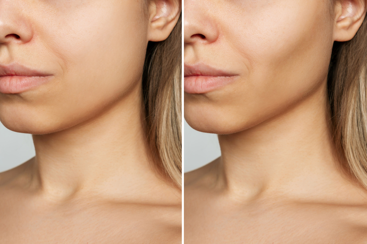 The Ins and Outs of Buccal Fat Removal